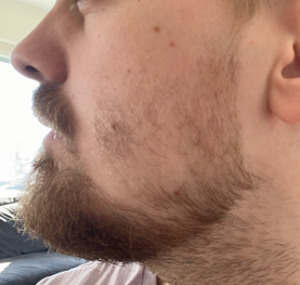 Beard before minoxidil