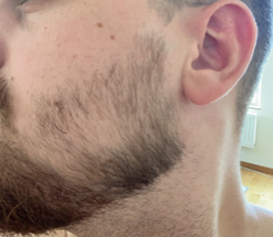 2 months minoxidil for beard