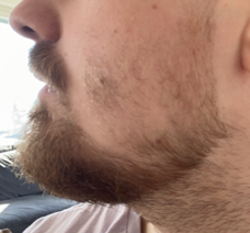 starting minoxidil for beard