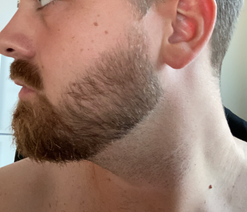 3 months minoxidil for beard