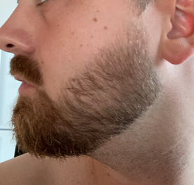 Beard after minoxidil
