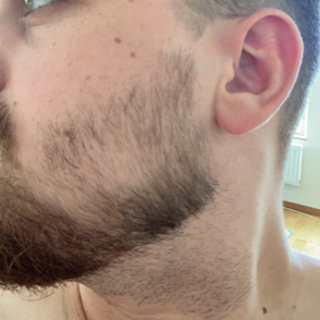 Minoxidil skägg
