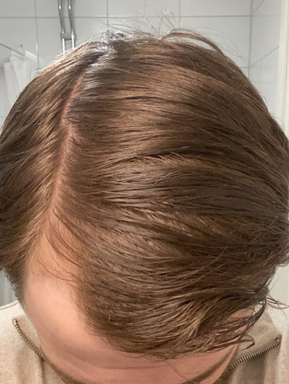Hår efter minoxidil