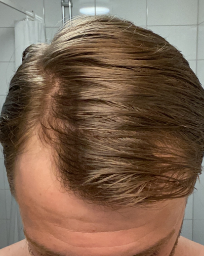 3 månader av minoxidil