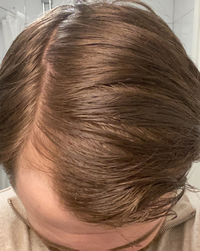 1 år av minoxidil