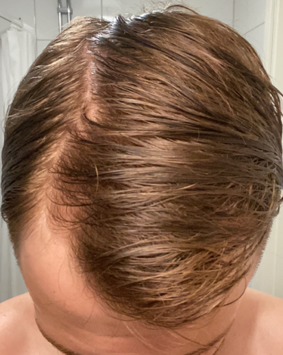 6 månader av minoxidil