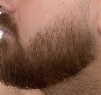 Minoxidil skägg före och efter – 1 års resultat