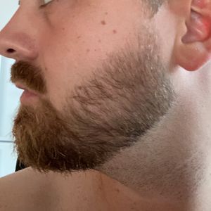 Minoxidil skägg