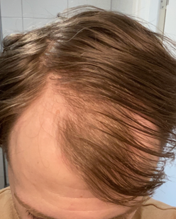 Före minoxidil