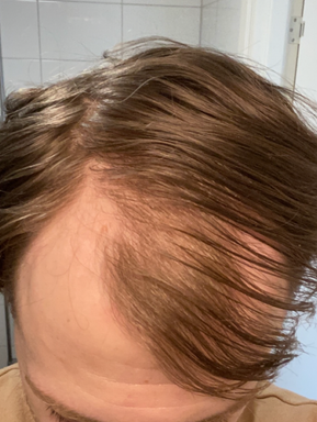 Hår innan minoxidil