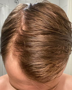 Efter minoxidil